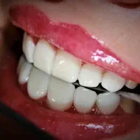 کامپوزیت دیجیتال و لمینیت با شرایط استثنایی در لار|خدمات آرایشگری و زیبایی|لار, |دیوار