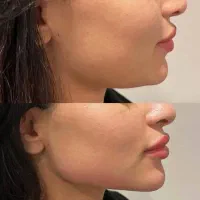 خدمات تخصصی تزریق ژل و بوتاکس|خدمات آرایشگری و زیبایی|فولادشهر, C3|دیوار