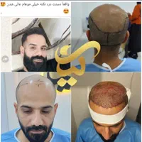 پکیج تخفیفی کاشت مو لیان