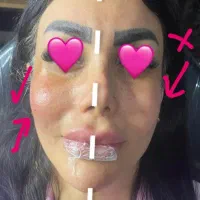 ژل بوتاکس مزو