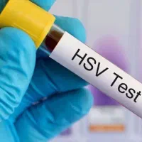 درمان قطعی زگیل و تبخال تناسلی