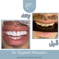 کامپوزیت تخصصی تمام قسطی (اقساط) قیمت سال قبل