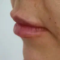 مدل ژل وبوتاکس وخال برداری بادستگاه