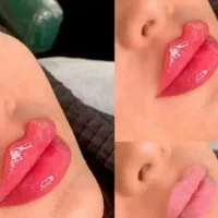 (کلینیک زیبایی) فیلر،بوتاکس مزوژل جوانساز، ضدلک|خدمات آرایشگری و زیبایی|قشم, |دیوار