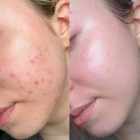 تخفیف ویژه فقط امروز برای کرم های ضدلک اصل