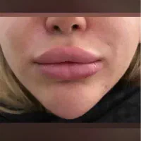 آموزش تخصصی ژل و بوتاکس|خدمات آموزشی|تهران, تهرانپارس شرقی|دیوار