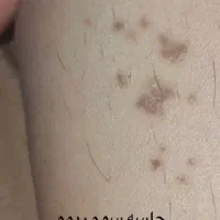 پاک کردن تتو با دستگاه کیوسوییچ تضمینی