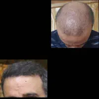 کاشت مو/کاشت ابرو/کاشت ریش/بالاترین تراکم/تضمینی|خدمات آرایشگری و زیبایی|مشهد, سجاد شهر|دیوار