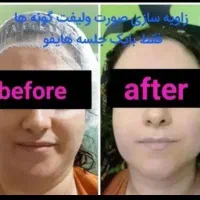 هایفوتراپی صورت ،رفع غبغب ،لاغری امبدینگ،خالبرداری