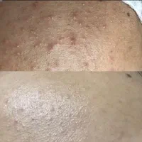 فشیال پوست رفع لک در مطب زیبایی .بانوان -اقایان