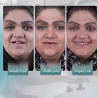 ایمپلنت با کمترین درد،کامپوزیت و لمینیت|خدمات آرایشگری و زیبایی|مشهد, جانباز|دیوار