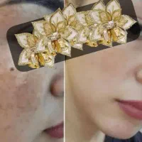 درمان سریع کک مک و لایه برداری پوست سفیده کننده|آرایشی، بهداشتی، درمانی|جیرفت, |دیوار