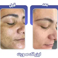 برداشتن خال۱۰ هزار تومن دریک جلسه،فیلر۳۹۰،جوانسازی|خدمات آرایشگری و زیبایی|کرج, گوهردشت|دیوار