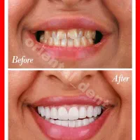 بریج و کامپوزیت و لیفت لثه جرمگیری دندان عصبکشی|خدمات آرایشگری و زیبایی|تهران, تهرانپارس غربی|دیوار