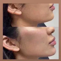 جشنواره تزریق بوتاکس و ژل فیلر چانه گونه زاویه لب|خدمات آرایشگری و زیبایی|فردیس, فردیس|دیوار
