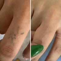 ۴۰٪ تخفیف پاک کردن تتو و خالکوبی با لیزرQ-switch|خدمات آرایشگری و زیبایی|کرمانشاه, |دیوار