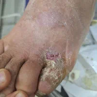 کارشناس زخم دیابت،سوختگی ،زخم بستر،وکیوم ،اسکار