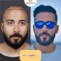 کاشت مو فقط با پرداخت ۱۰ میلیون|خدمات آرایشگری و زیبایی|تهران, جردن|دیوار