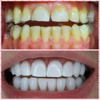 کامپوزیت دندان درمحل شمامنزل یامحل کار|خدمات آرایشگری و زیبایی|هشتگرد, شهرک گلخانه|دیوار