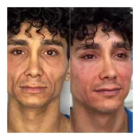 آموزش خدمات بوتاکس فیلر با سابقه|خدمات زیبایی و سلامت|شیراز, کوشک میدان|دیوار