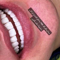 ٪۴۰ تخفیف کامپوزیت دندان اقساط ( بدون سود )|خدمات آرایشگری و زیبایی|شیراز, معالی‌آباد|دیوار