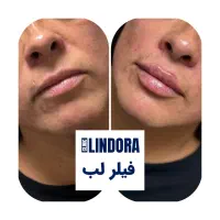 جشنواره عیدانه کلینیک زیبایی لیندورا|خدمات آرایشگری و زیبایی|تهران, درختی|دیوار