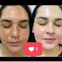 کرم برطرف کننده لکه و جای جوش