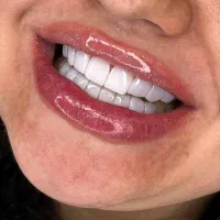 دندان پزشکی کامپوزیت لمینت|خدمات زیبایی و سلامت|مشهد, فرهنگ|دیوار