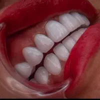 کامپوزیت دندان.لمینت دندانپزشکی. ایمپلنت.عصب کشی|خدمات آرایشگری و زیبایی|تهران, تهرانپارس جنوبی|دیوار