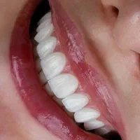 دندانپزشکی از دم قسط ایمپلنت کامپوزیت عصبکشی روکش