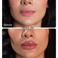 تزریق ژل و بوتاکس|خدمات آرایشگری و زیبایی|اهواز, کوروش|دیوار
