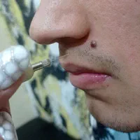 برداشتن زگیل تناسلی برای آقایان و خانم هادریکجلسه|خدمات آرایشگری و زیبایی|کرج, گلشهر|دیوار