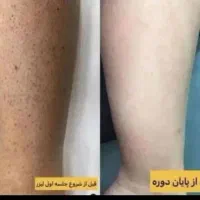 لیزر خانم آقا ژل بوتاکس هایفو لاغری امبدینگ|خدمات آرایشگری و زیبایی|سیرجان, |دیوار