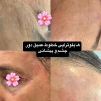 هایفوتراپی و آر اف|خدمات آرایشگری و زیبایی|قم, دورشهر|دیوار
