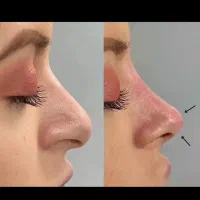 فیلربینی.آنزیم.عمل بینی،تیپ پلاستی،رینوپلاستی