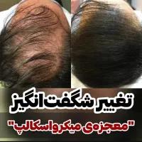 میکرو اسکالپ پوشش کم‌پشتی مو با رنگدانه|خدمات آرایشگری و زیبایی|تهران, حر|دیوار