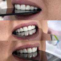 (زیبایی) ونییر کامپوزیت و لمینیت، بلیچینگ|خدمات آرایشگری و زیبایی|رشت, گلسار|دیوار