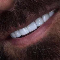 دندانپزشکی،کامپوزیت دندان،روکش دندان|خدمات آرایشگری و زیبایی|شیراز, شهرک ولیعصر|دیوار