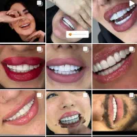 کامپوزیت زیبایی