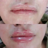 آف ویژه فیلر|خدمات آرایشگری و زیبایی|مشهد, شهید آوینی|دیوار