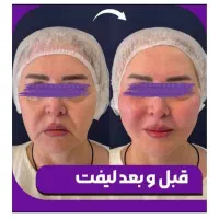 مرکز تخصصی جوانسازی اندولیفت/هایفو/لیفت فقط۸۹۰ت