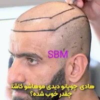 کاشت فوق حرفه/جدیدترین متدسوپرمیکروit+ مو/ابرو/ریش|خدمات آرایشگری و زیبایی|مشهد, هفت تیر (آب و برق)|دیوار