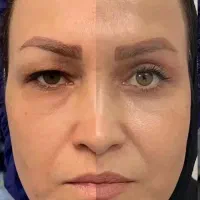 کرم۱۵کاربیوممتیک ضدچروک وضدلک درمان افتادگی پلک