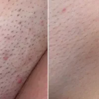 لیزر موهای زائد۳۹۰|خدمات آرایشگری و زیبایی|بابل, |دیوار