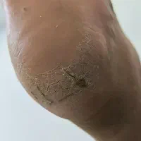 دوست داری ترک پاهات درمان بشه با یه قیمت منصفانه