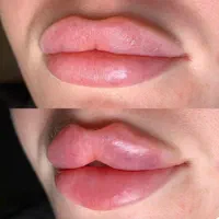 فیلر لب ژل گونه فک بوتاکس لیزرساکشن غبغب کاشت مو|خدمات آرایشگری و زیبایی|رشت, گلسار|دیوار