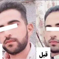 چاقی صورت و کل بدن