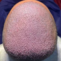 کاشت مو و ابرو