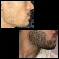ته ریش|آرایشی، بهداشتی، درمانی|اردبیل, |دیوار