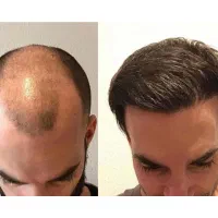 پایان طاسی، شروع اعتماد به نفس کاشت مو در شهر قدس